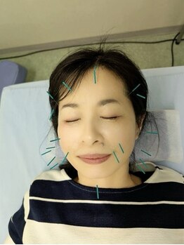 辻鍼灸接骨院の写真/美容鍼灸でリフトアップ、憧れの小顔に♪お顔のコリをほぐして、たるみ改善・むくみもスッキリ！