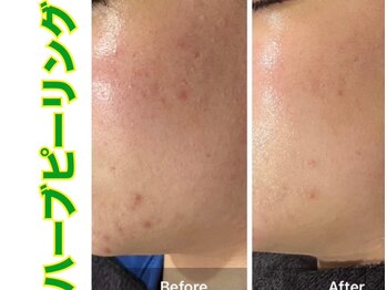 ブレア(Blair)/漢方ハーブピーリング