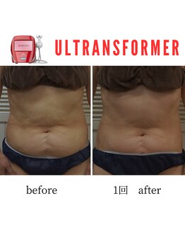 アップルミント/＜痩身＞before・after