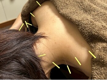 なかざわ鍼灸整骨院の写真/《鍼が初めての方にもおすすめ》ツボを刺激して筋肉へアプローチ!鍼灸・カッピングからお好きな方を選択◎