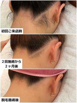 プレヴェール 神戸三宮/うなじ脱毛