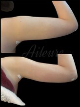 エルール トータルビューティ(Aileure total beauty)/二の腕術後ケア