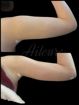 エルール トータルビューティ(Aileure total beauty)/二の腕術後ケア