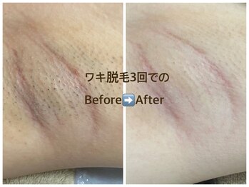 リゲルス(Regel)の写真/脱毛デビューにオススメ！効果の実感も早いケアで理想の自分へ一歩前進♪