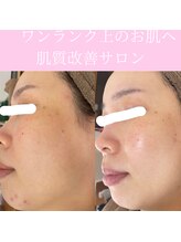 ミエル(miel)/【ハーブピーリング】毛穴ケア