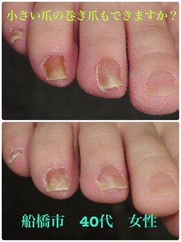 巻き爪じゅん 千葉駅前店/小さい巻き爪・親指以外も可能？