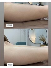 ルシェル(Le.ciel)/脚脱毛