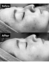 チル(Chill)/【シミ改善】2ヶ月の変化