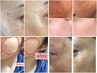 【光フェイシャル】しみケア、たるみケア、毛穴ケア、ハリ、透明感◎¥11800→