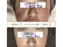 ギャラクシービューティー(galaxy beauty)の雰囲気（《人気No1》しみケア）