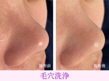 オーシャンブルー 大分店(OCEAN BLUE)/毛穴洗浄