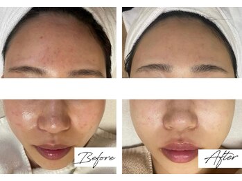 ビズビズ 梅田店(bisebise)/ニキビケア/ハイドラ毛穴洗浄