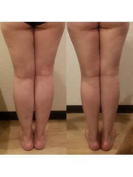 トータルエステティック ジョワイユ(JOYEUX)/脚集中ケア