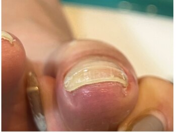 ウルネイルスタジオ(Uru nailstudio)の写真/靴を履いてて痛い、とお悩みの方へ！【巻き爪の悩みを解消★】カウンセリング＆サロン独自の技術♪
