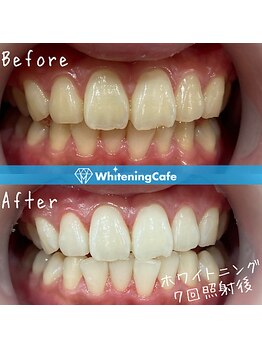 ホワイトニングカフェ 池袋東口店/ホワイトニングビフォーアフター