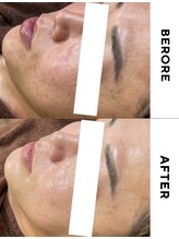 ゼロ(ZERO)/ダクトピール