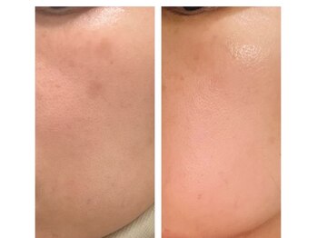 ミラ 中央林間(mira)の写真/毛穴洗浄で肌の汚れをごっそり！自宅で出来ない透明感とツヤ肌で肌質改善へ★