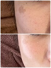 ロッシュ フェイス(Roche Face)/20代女性