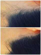 ラヴィ(Lavie)/うなじ脱毛　Before/After