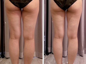 エイプリル/【痩身】比較写真