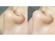 ニーズ(NIEES)の写真/どこに行っても取れなかった毛穴の汚れ・黒ずみ・角栓を徹底洗浄！徹底吸引！つるすべ肌へ導きます◎