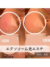 パルティノ 高崎店/1回目体験・40代・頬の毛穴開き