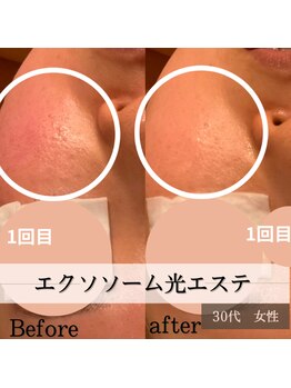 パルティノ 高崎店/1回目体験・40代・頬の毛穴開き