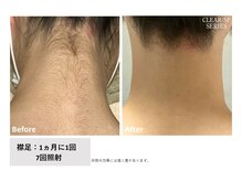 フィルムス(FILMS.)/女性の襟足脱毛のBeforeAfter