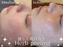 剥離なしでも効果抜群★不動の人気No. 1メニューで肌質改善♪