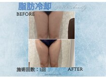 ユアーズビューティー(YOURS beauty)/脂肪冷却