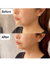 ヒカリエステ 六本木(HIKARI ESTHE)/切らない小顔リフト