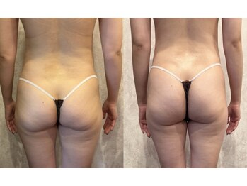 ブリア 横浜(BRILLA)/下半身ケアで美尻！？