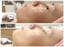 シルク(Cilk)/ハーブクリームピーリング