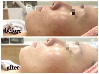 シルク(Cilk)/ハーブクリームピーリング