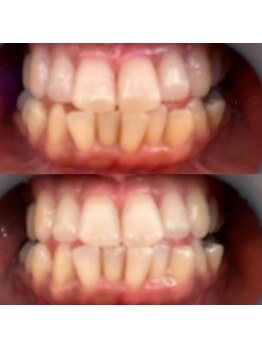 サロン ド ミモザ(Salon de Mimosa)/セルフホワイトニング