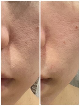 レヴィオ(REVIO)/フェイシャル肌変化