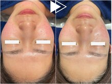 リシェス(Richesse)/毛穴改善ハーブ★初回¥11990