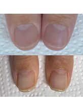 ウェルズユキ(well's yuki)/町田　自爪育成　効果