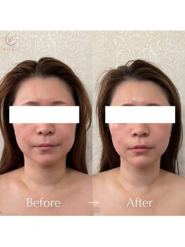 セラピエージ/浮腫み解消