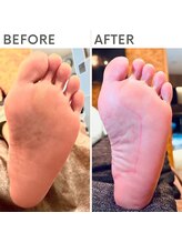 クオッカ(Quokka)/足裏のたこ・角質ケア