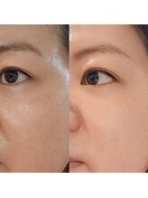 友スック ガピ かわぐち店(友SSOOK Gapi)/ハーブピーリング