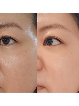 友スック ガピ かわぐち店(友SSOOK Gapi)/ハーブピーリング