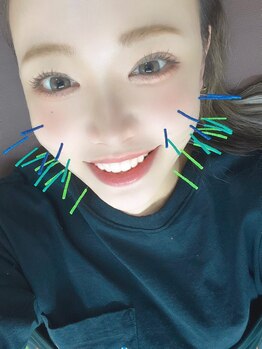 ハリトマト 梅田中崎/施術(浮腫・シワ)