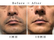 モンシェリ 広島店(Mon Cheri)/男性ヒゲ脱毛Before→After