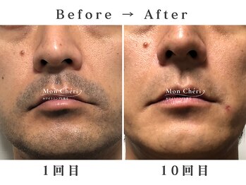 モンシェリ 広島店(Mon Cheri)/男性ヒゲ脱毛Before→After
