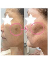 オルオル(Olu'olu)/シミ消し美白フェイシャル