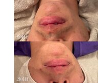 カシェット(cachette)/メンズヒゲ脱毛施術回数1回