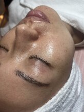 スパークル/ワックス/脱毛/ニキビケア