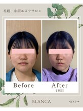 ブランカ(BLANCA)/小顔セラピアビフォーアフター