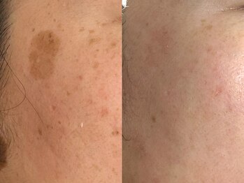 プレナ(PLENA)/人生を変えるシミプログラム